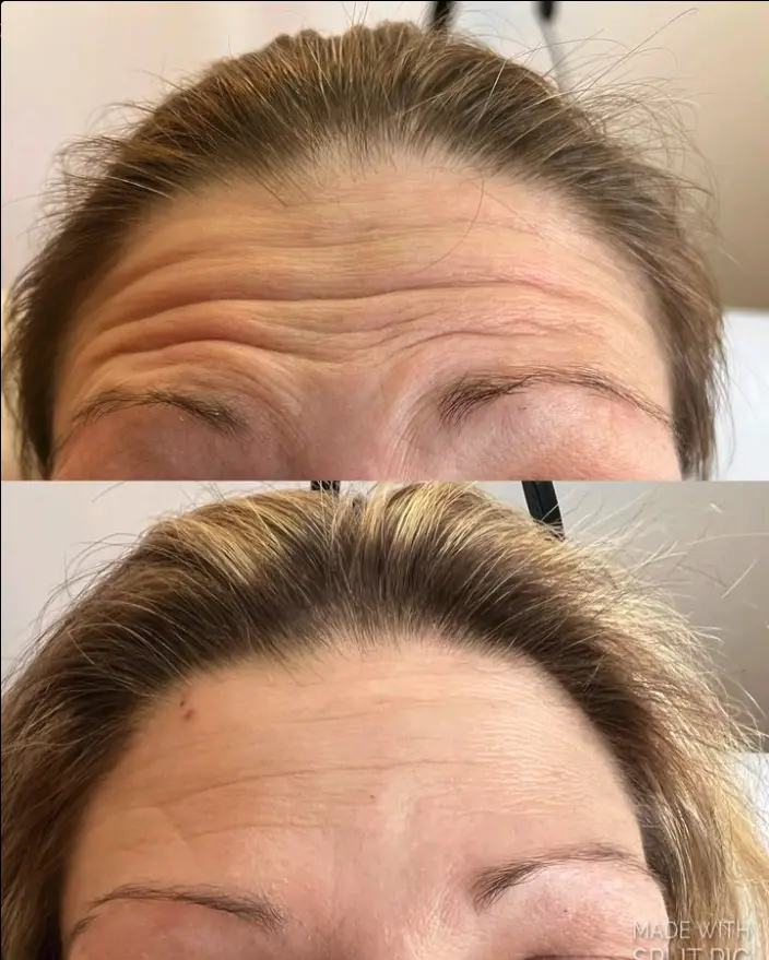 5 Surprising Uses of Botox You Didn't Know About